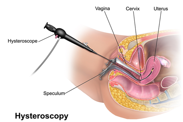 Robotic Hysterectomy