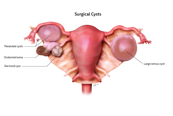 Robotic Cystectomy