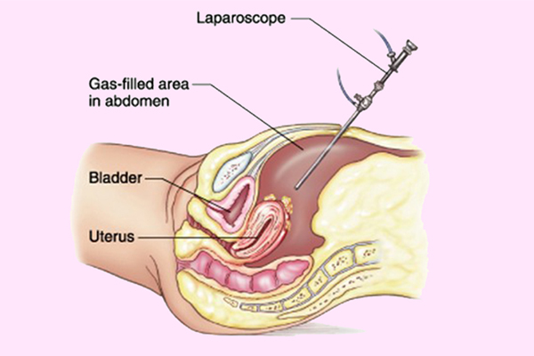 Laparoscopic Hysterectomy