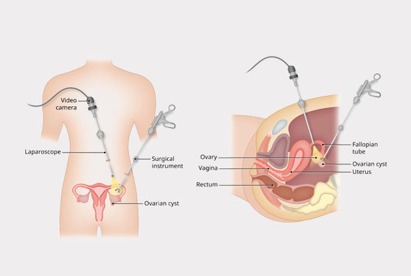 Laparoscopic Cystectomy