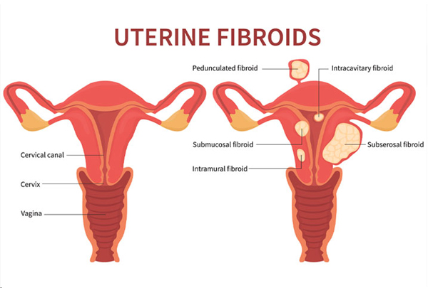 Laparoscopic Fibroid Treatment