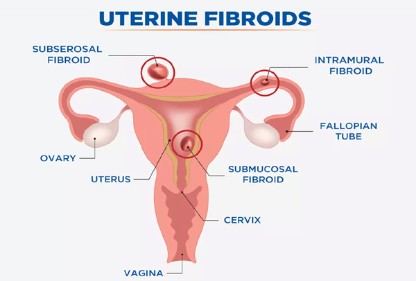 Fibroid Treatment