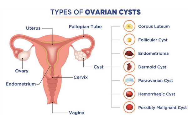 Ovarian Cyst Treatment