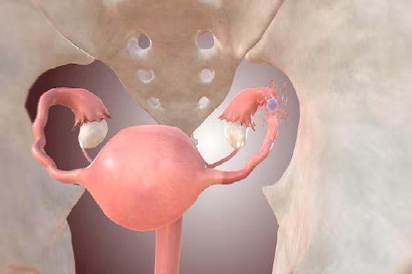 Ectopic Pregnancy Treatment