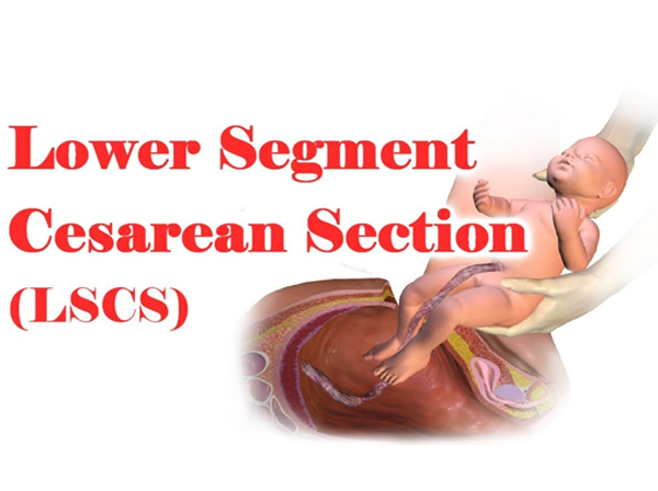 LSCS